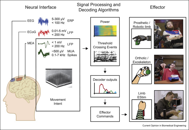 Upper limb sensorimotor restoration through brain–computer interface technology in tetraparesis