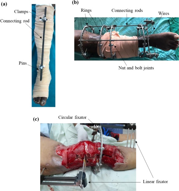 An engineering review of external fixators