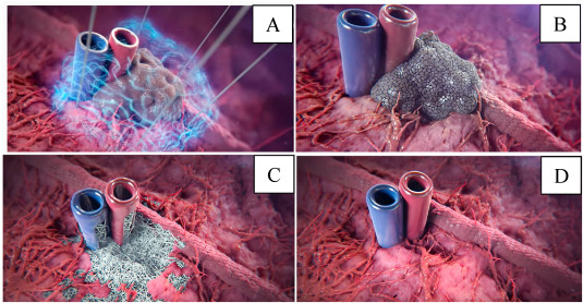 Electroporation combined with intelligent drug delivery promising new and clean approach to cancer tr